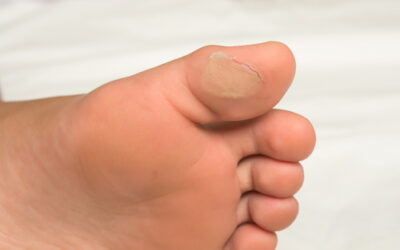 Blisters