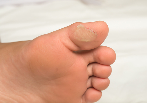 Blisters