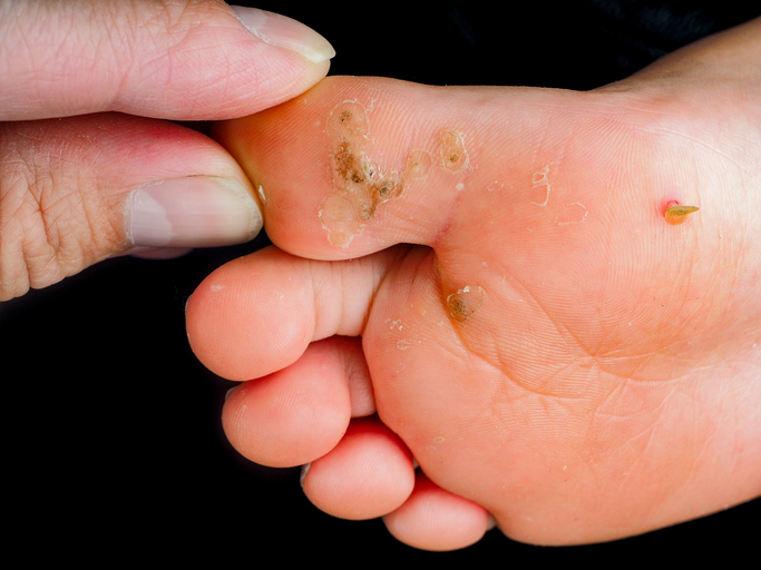 Child's foot sole, with verruca, wart, callus isolated towards black. Touched by fingers of a pediatrician, doctor