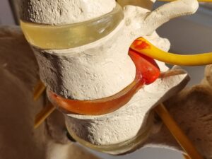 slipped disc